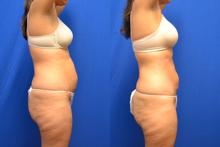 Thermi before and after photo by AmaChi MedSpa in Marietta, GA