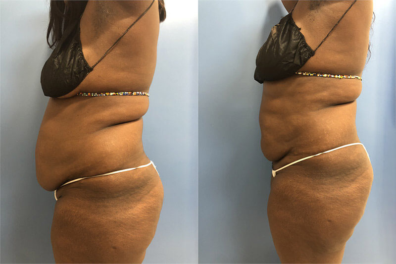 Thermi before and after photo by AmaChi MedSpa in Marietta, GA