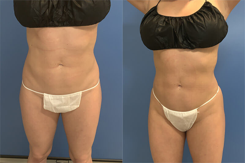 Emsculpt before and after photo by AmaChi MedSpa in Marietta, GA