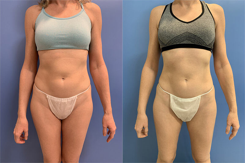 Emsculpt before and after photo by AmaChi MedSpa in Marietta, GA