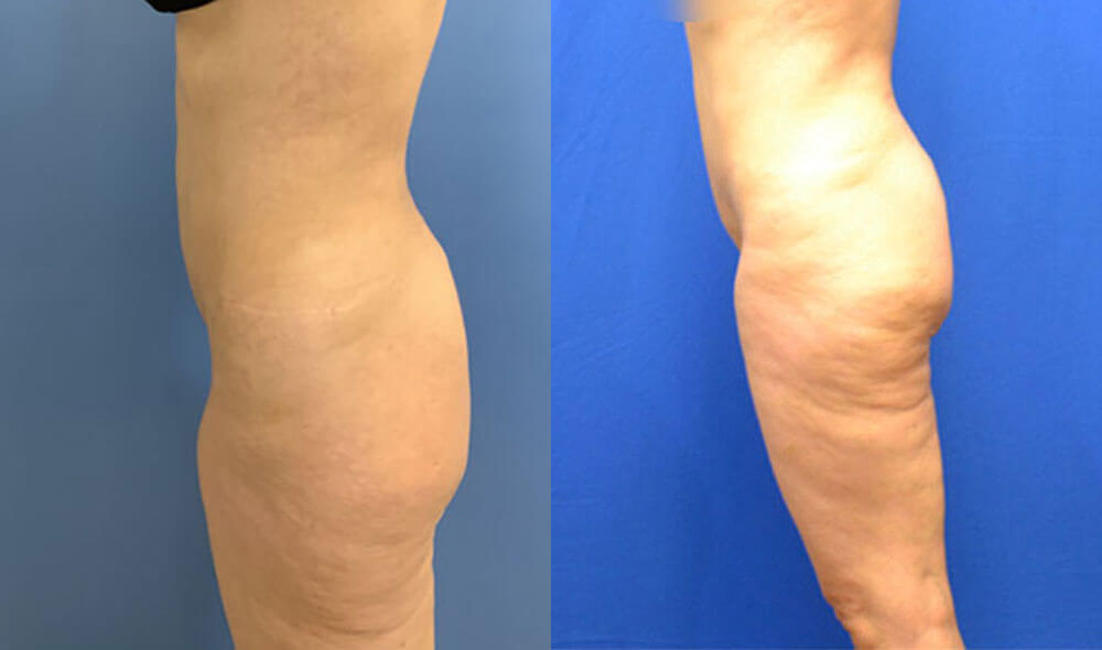 Emsculpt before and after photo by AmaChi MedSpa in Marietta, GA