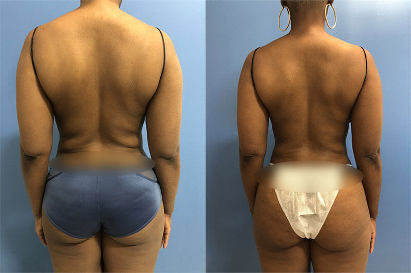 CoolSculpting before and after photo by AmaChi MedSpa in Marietta, GA