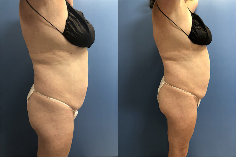 CoolSculpting before and after photo by AmaChi MedSpa in Marietta, GA