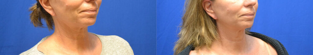 ThermiFace before and after photo by AmaChi MedSpa in Marietta, GA