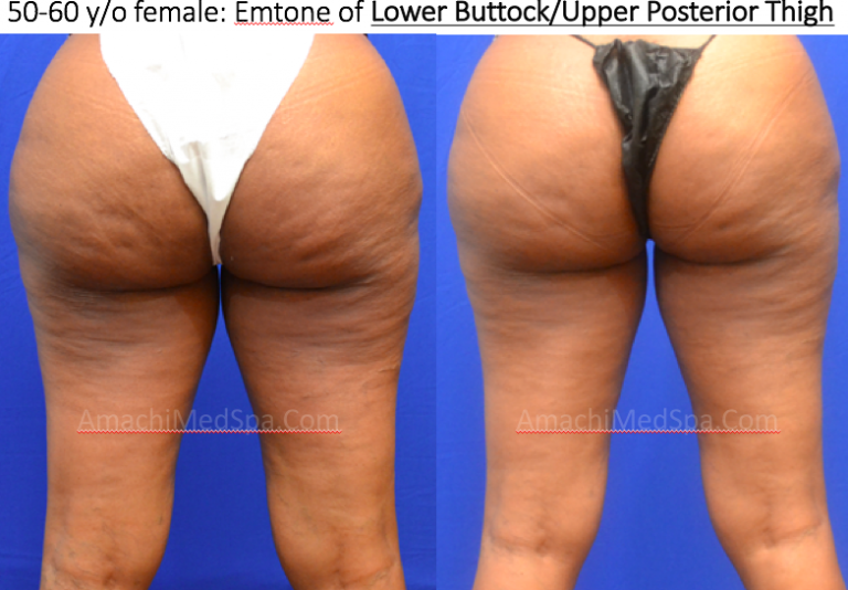 Emtone Buttock & Thighs