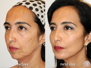 Before and after Y Lift at Amachi Medspa