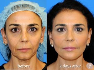 Before and after Y Lift at Amachi Medspa